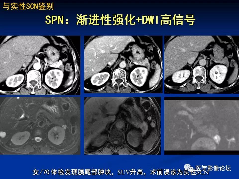 【PPT】胰腺囊性肿瘤影像学诊断与鉴别诊断