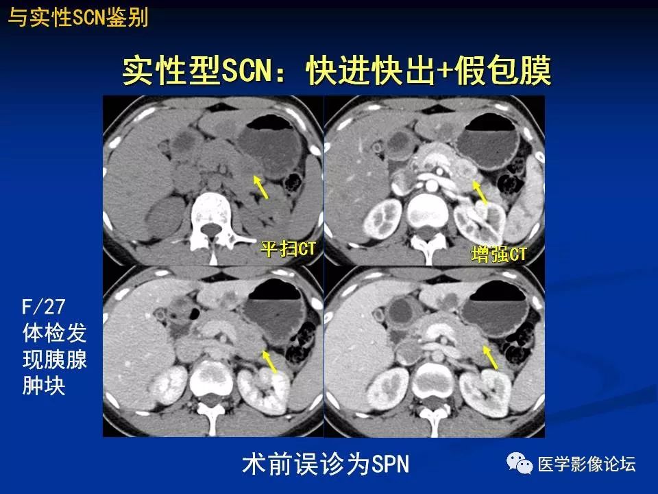 【PPT】胰腺囊性肿瘤影像学诊断与鉴别诊断