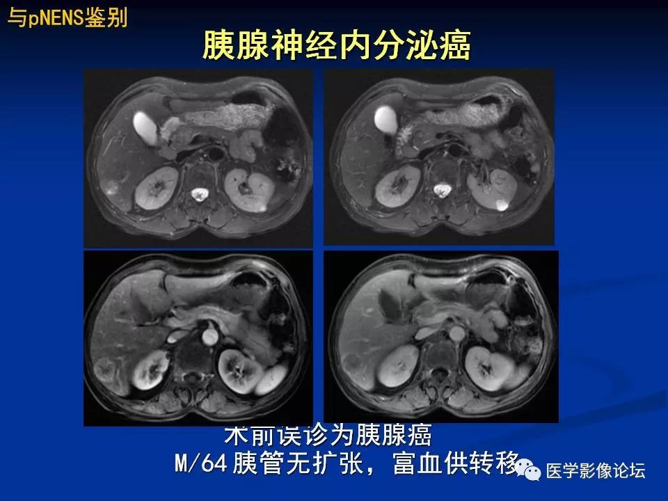 【PPT】胰腺囊性肿瘤影像学诊断与鉴别诊断