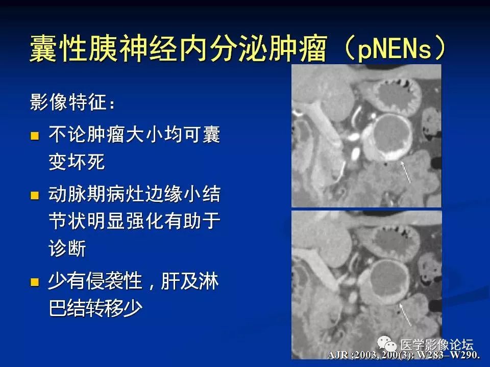 【PPT】胰腺囊性肿瘤影像学诊断与鉴别诊断
