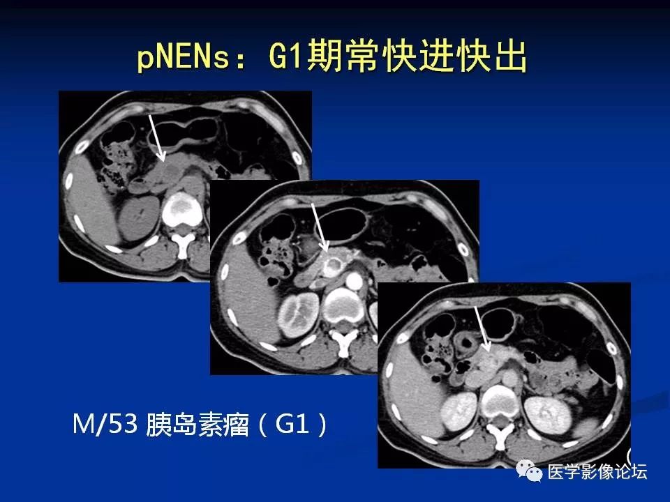 【PPT】胰腺囊性肿瘤影像学诊断与鉴别诊断