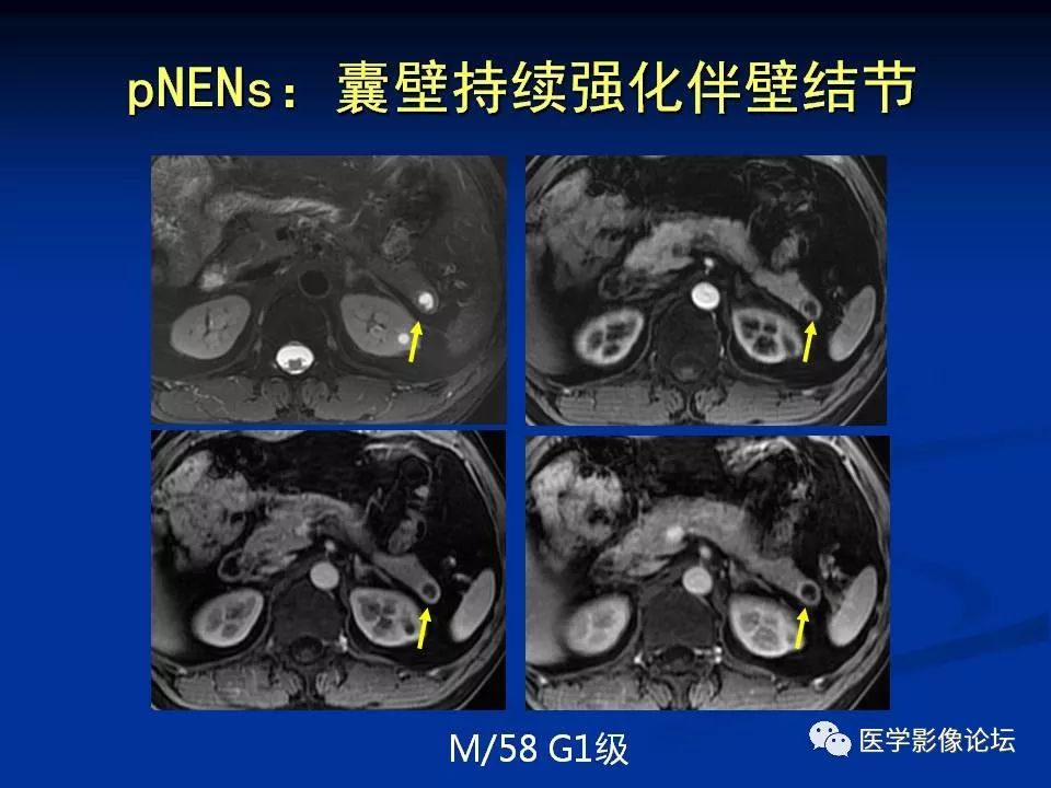 【PPT】胰腺囊性肿瘤影像学诊断与鉴别诊断