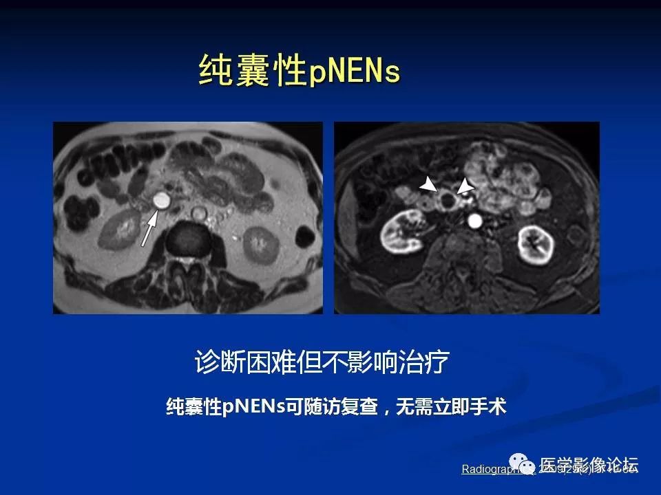 【PPT】胰腺囊性肿瘤影像学诊断与鉴别诊断