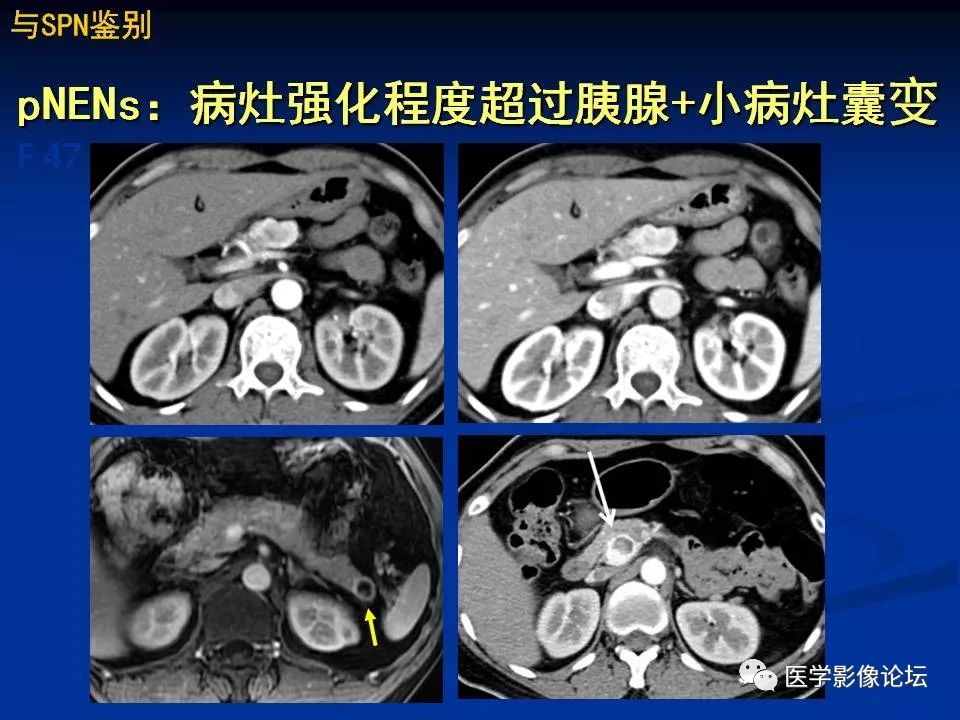 【PPT】胰腺囊性肿瘤影像学诊断与鉴别诊断