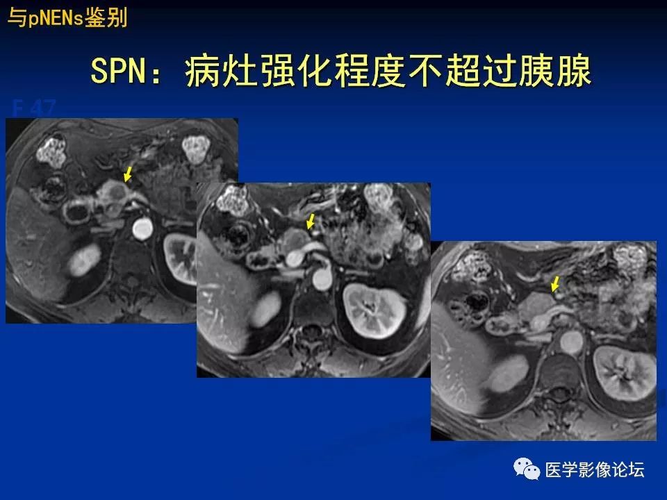 【PPT】胰腺囊性肿瘤影像学诊断与鉴别诊断