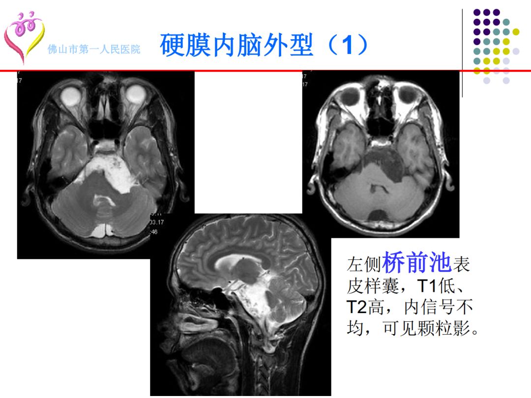 【PPT】颅脑表皮样囊肿的影像学特征
