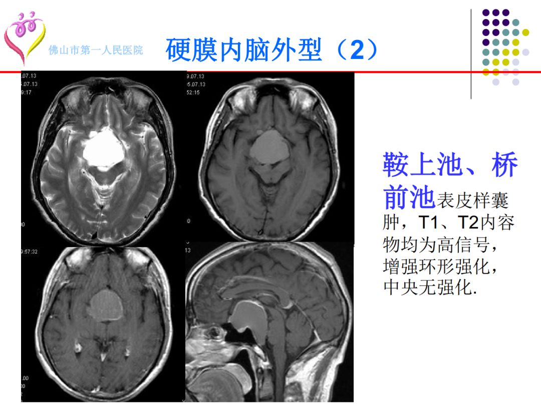 【PPT】颅脑表皮样囊肿的影像学特征