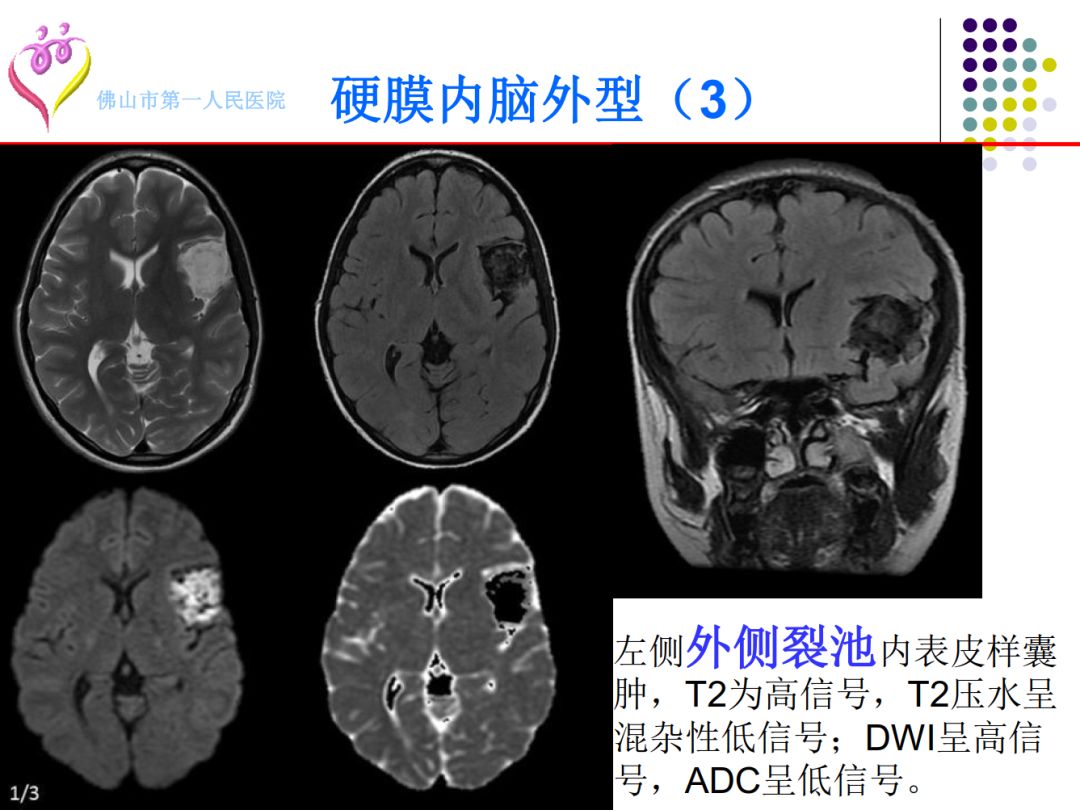 【PPT】颅脑表皮样囊肿的影像学特征