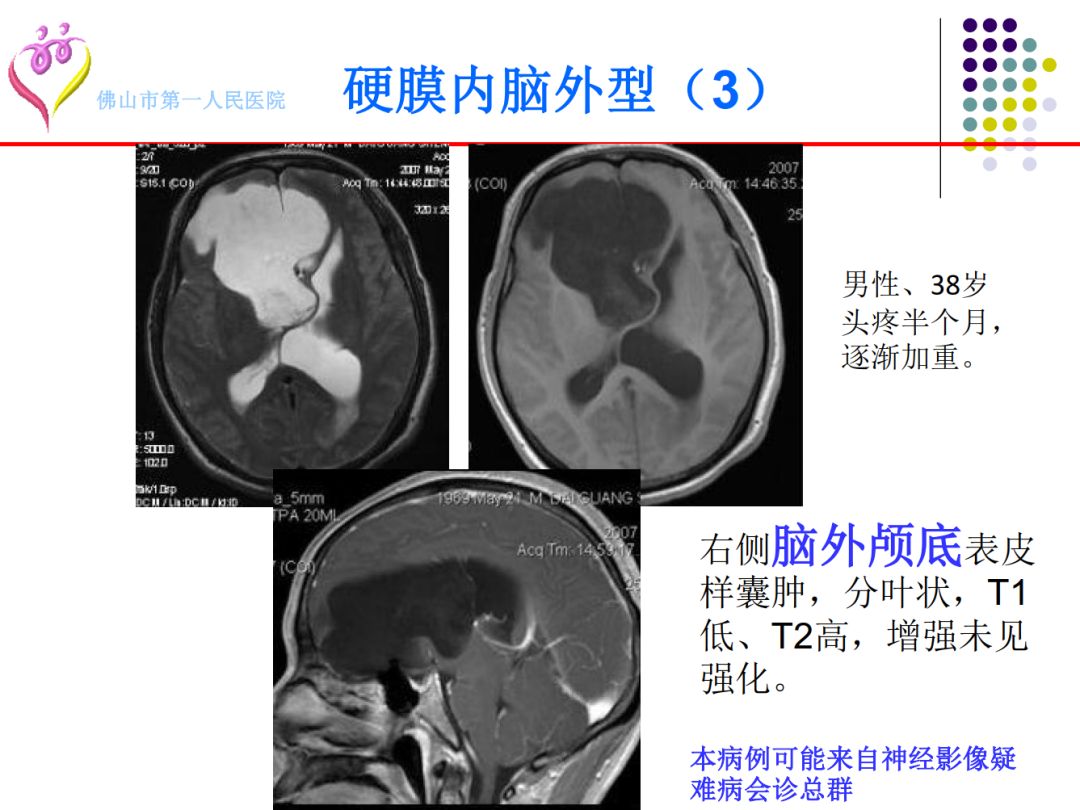 【PPT】颅脑表皮样囊肿的影像学特征
