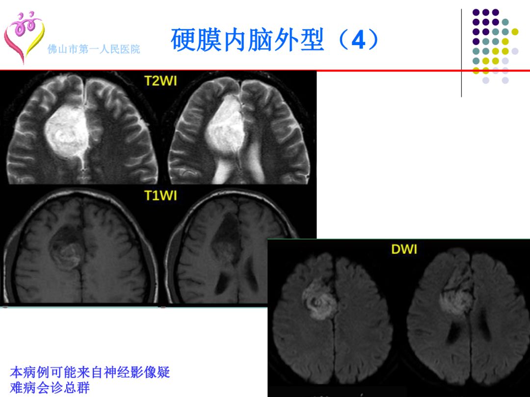 【PPT】颅脑表皮样囊肿的影像学特征