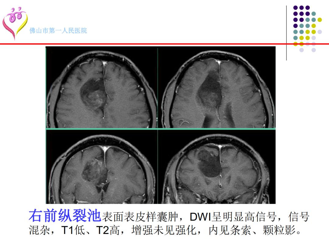 【PPT】颅脑表皮样囊肿的影像学特征