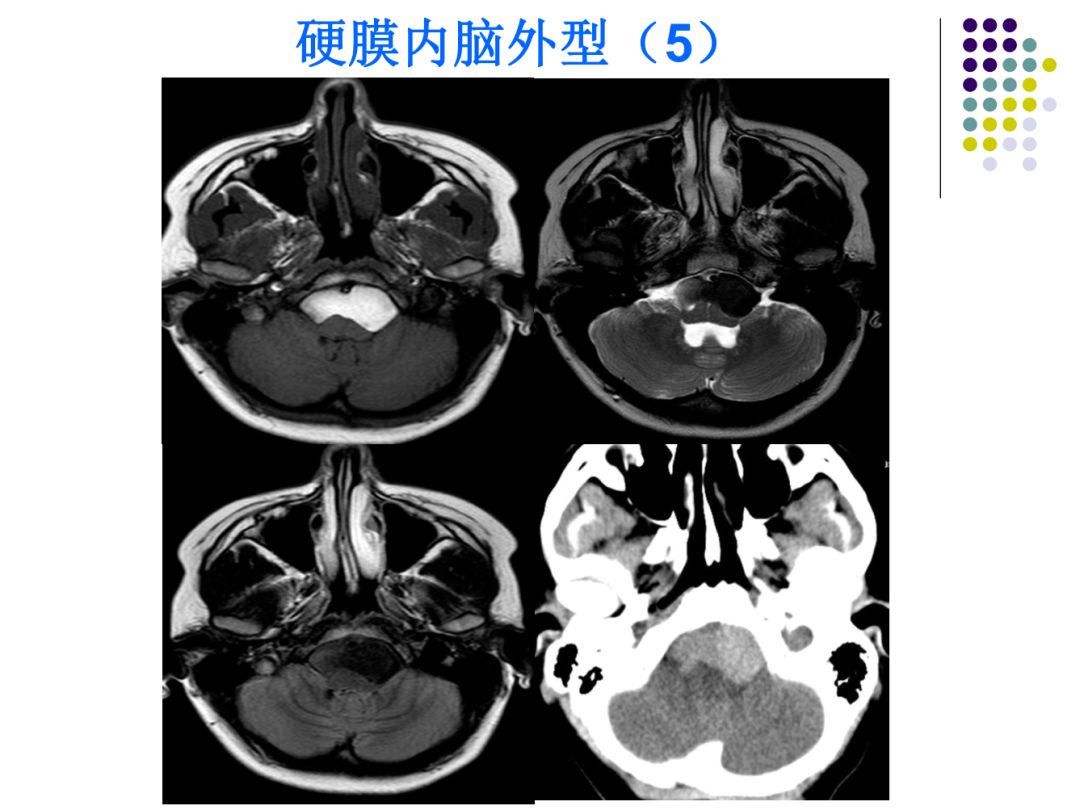 【PPT】颅脑表皮样囊肿的影像学特征