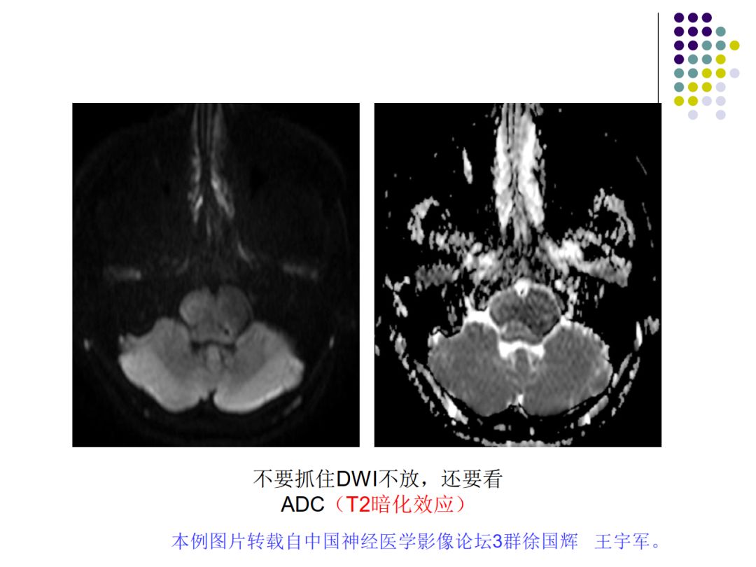 【PPT】颅脑表皮样囊肿的影像学特征