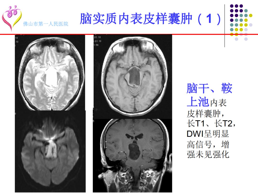 【PPT】颅脑表皮样囊肿的影像学特征