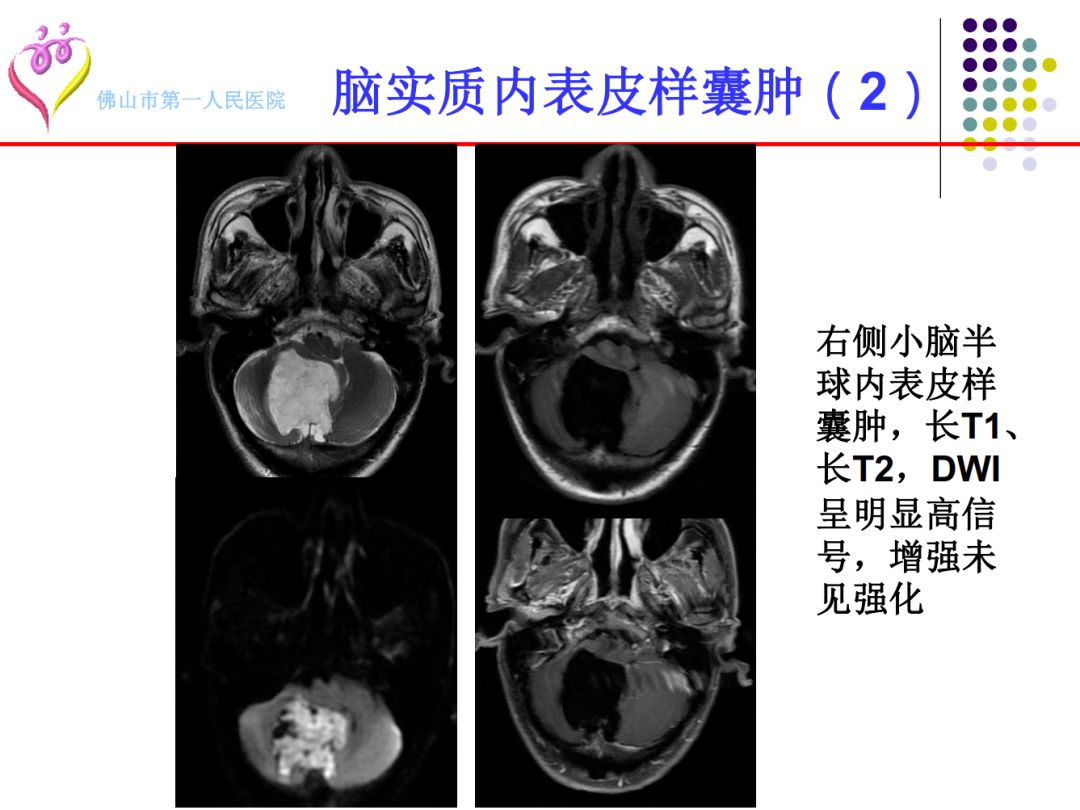 【PPT】颅脑表皮样囊肿的影像学特征