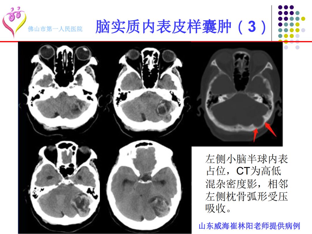 【PPT】颅脑表皮样囊肿的影像学特征