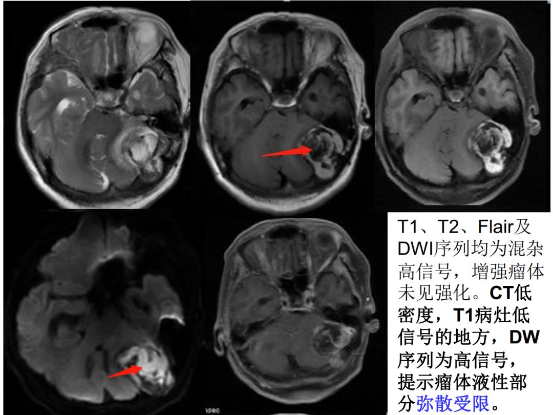【PPT】颅脑表皮样囊肿的影像学特征