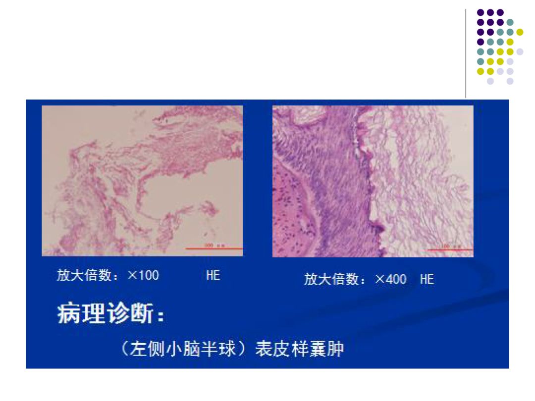 【PPT】颅脑表皮样囊肿的影像学特征