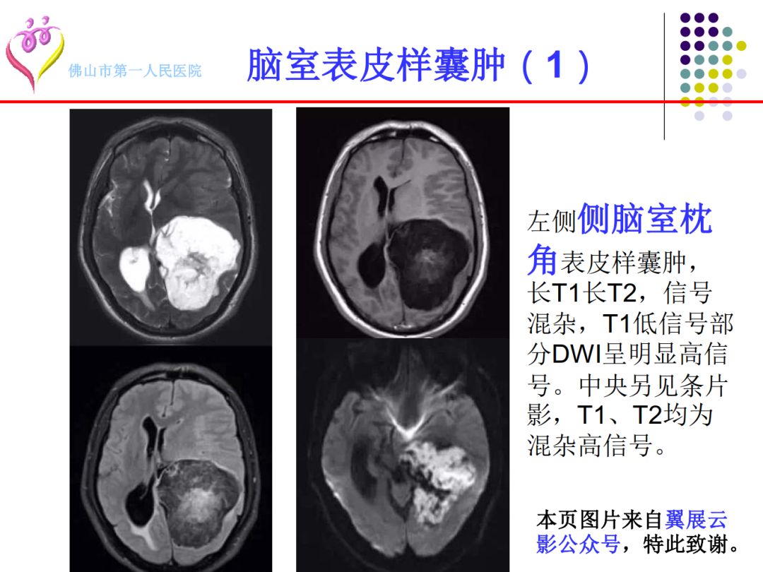 【PPT】颅脑表皮样囊肿的影像学特征