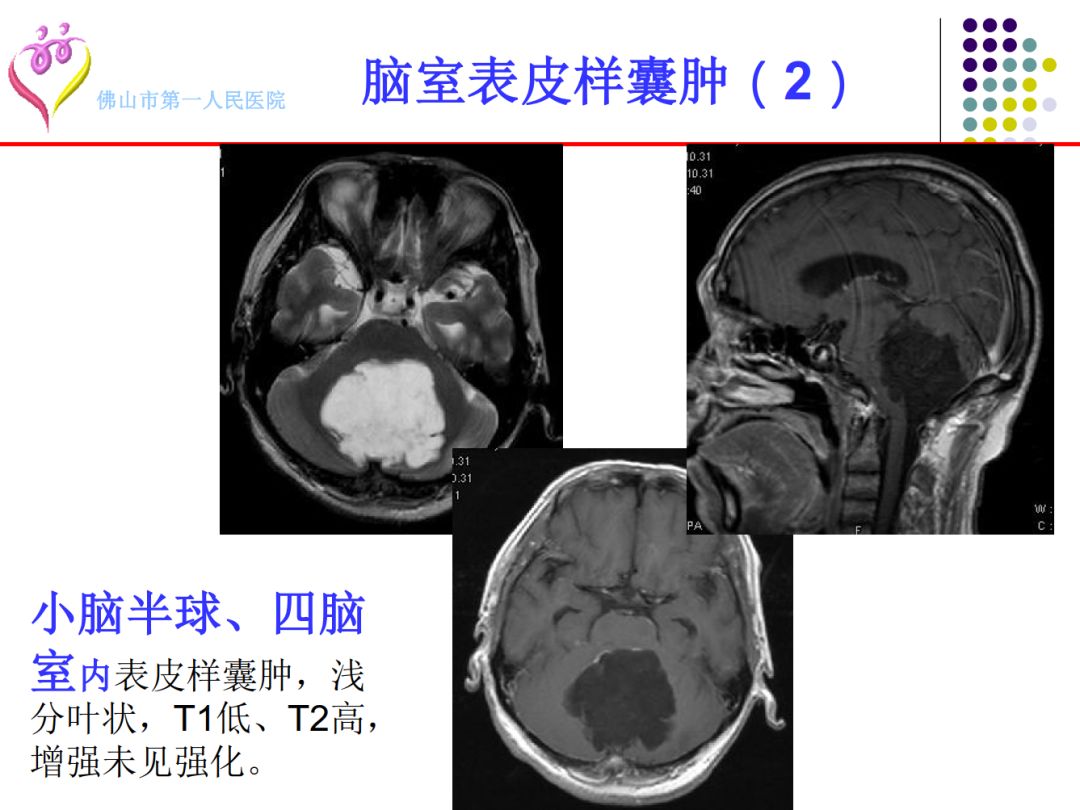 【PPT】颅脑表皮样囊肿的影像学特征