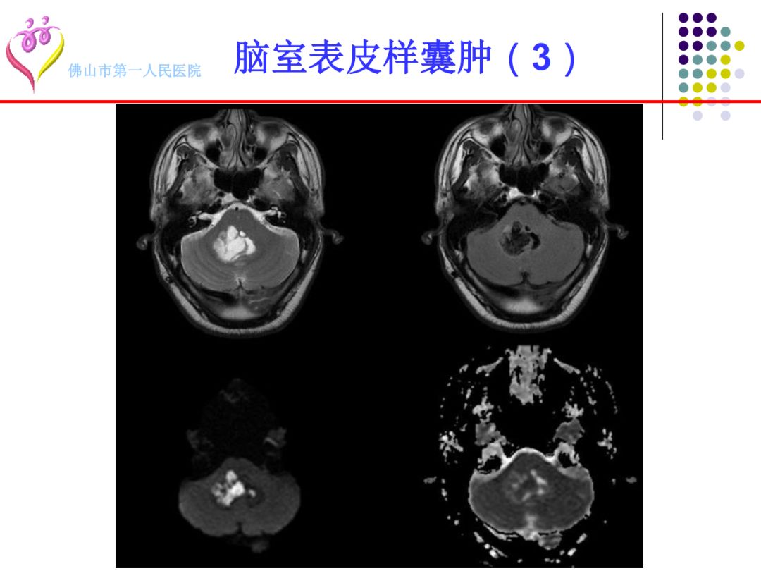 【PPT】颅脑表皮样囊肿的影像学特征