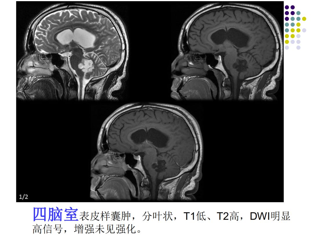 【PPT】颅脑表皮样囊肿的影像学特征