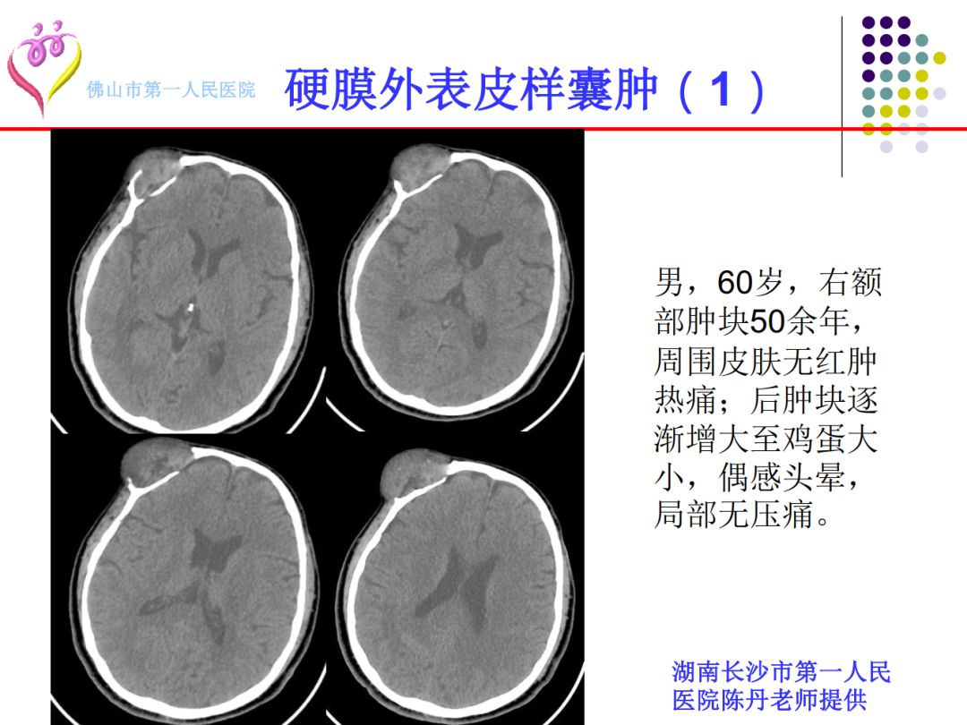 【PPT】颅脑表皮样囊肿的影像学特征