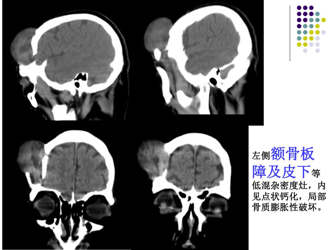 【PPT】颅脑表皮样囊肿的影像学特征