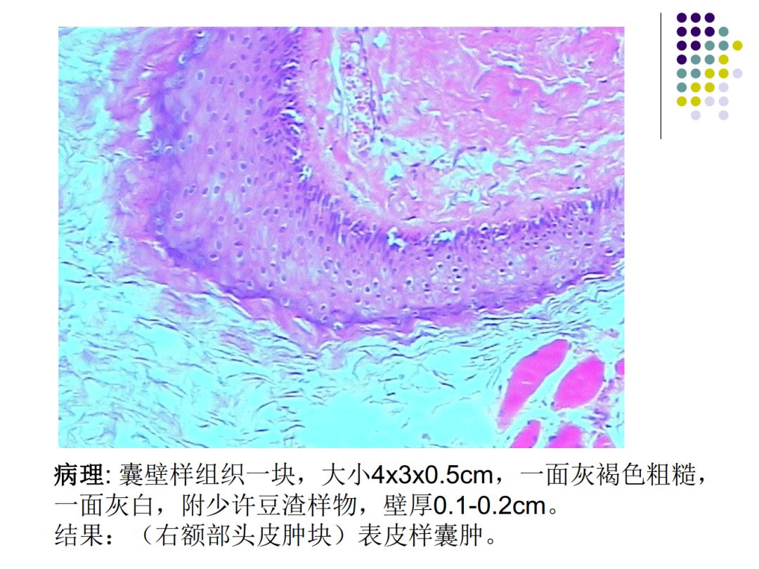 【PPT】颅脑表皮样囊肿的影像学特征