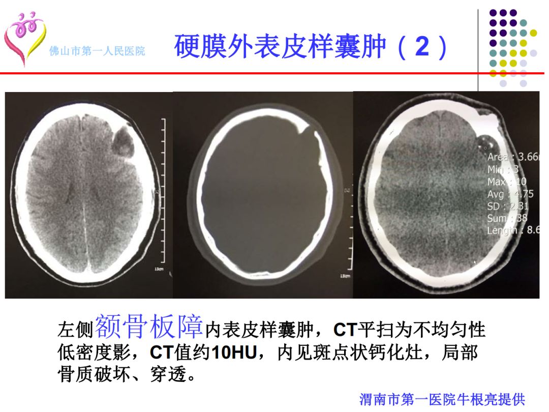 【PPT】颅脑表皮样囊肿的影像学特征