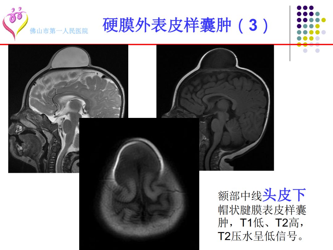 【PPT】颅脑表皮样囊肿的影像学特征