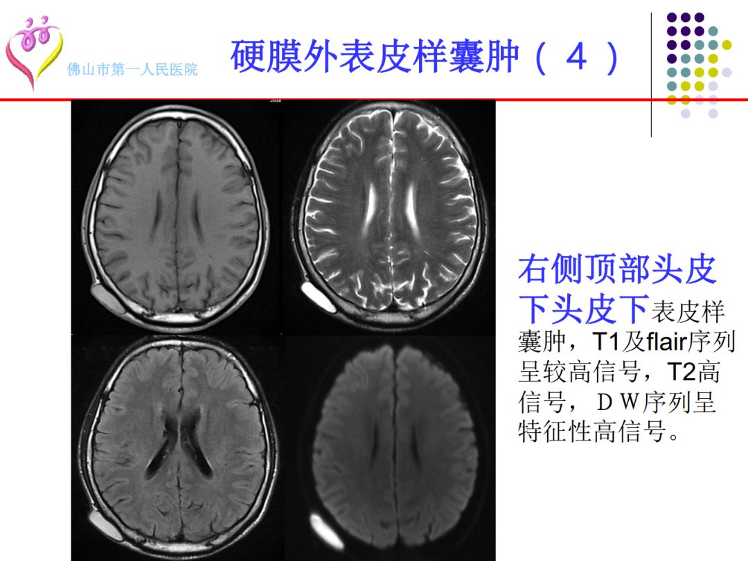【PPT】颅脑表皮样囊肿的影像学特征