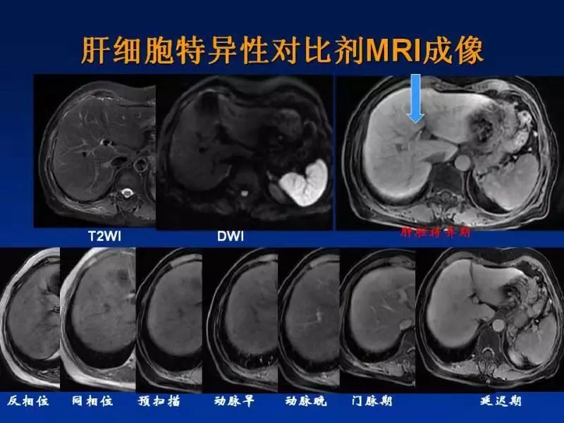【PPT】肝细胞特异性对比剂临床应用