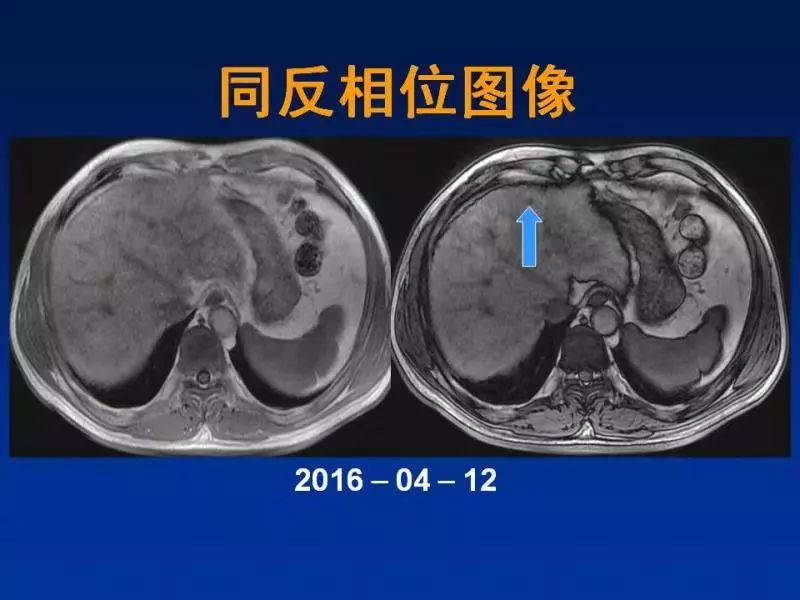 【PPT】肝细胞特异性对比剂临床应用