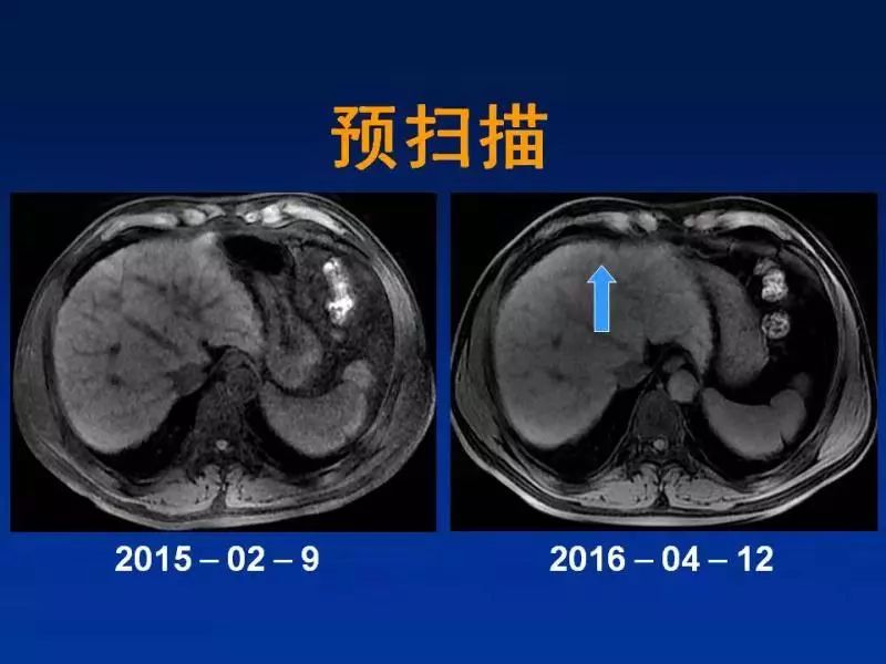 【PPT】肝细胞特异性对比剂临床应用