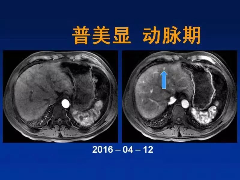 【PPT】肝细胞特异性对比剂临床应用