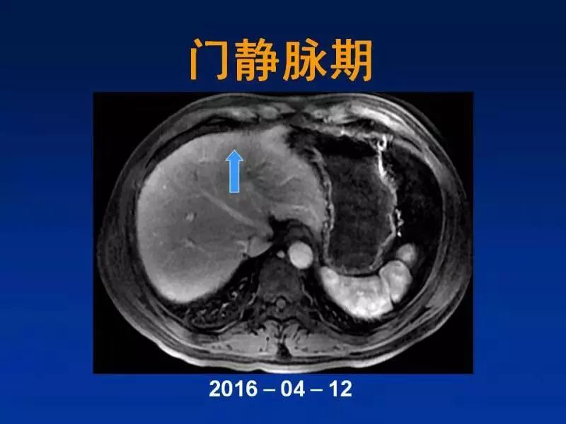 【PPT】肝细胞特异性对比剂临床应用