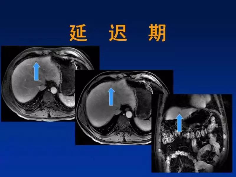 【PPT】肝细胞特异性对比剂临床应用
