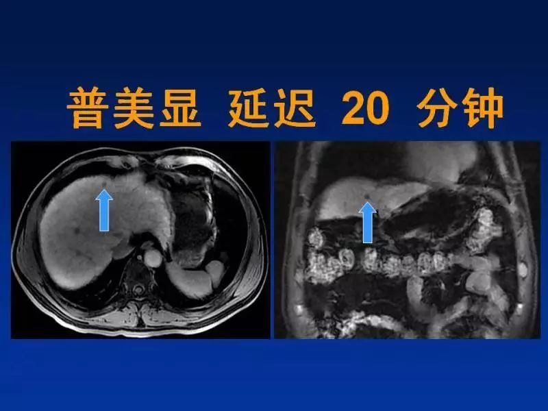 【PPT】肝细胞特异性对比剂临床应用
