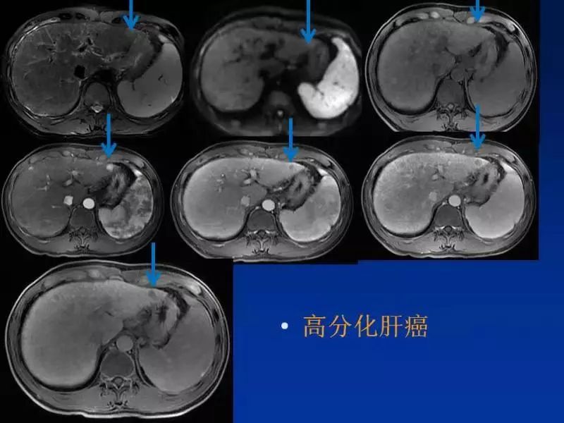 【PPT】肝细胞特异性对比剂临床应用