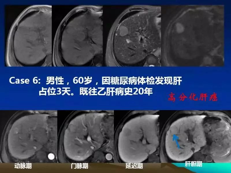 【PPT】肝细胞特异性对比剂临床应用