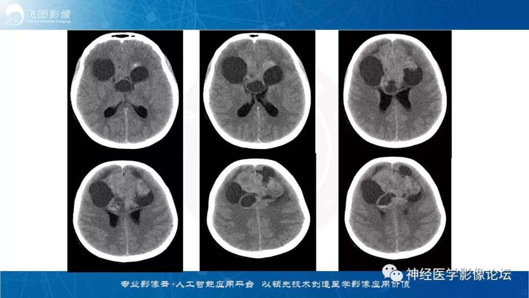 【病例】脑实质内室管膜瘤1例CT及MR影像表现