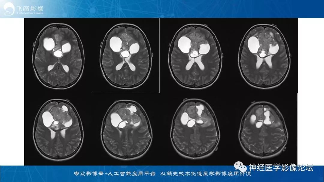【病例】脑实质内室管膜瘤1例CT及MR影像表现