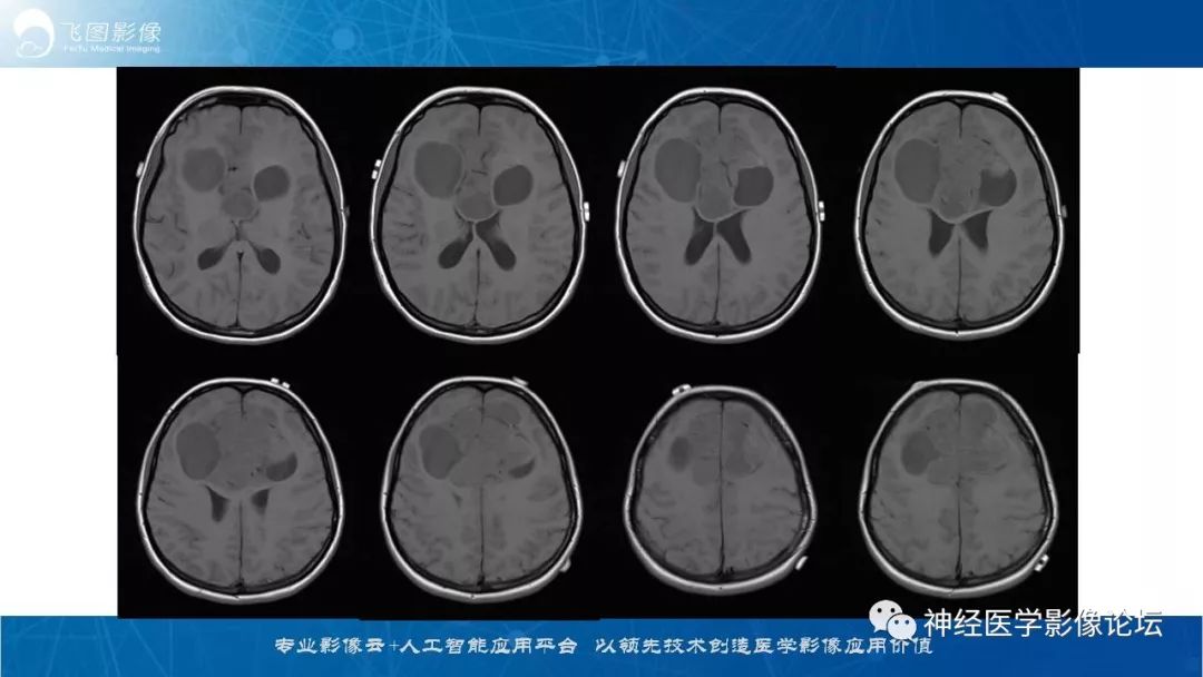 【病例】脑实质内室管膜瘤1例CT及MR影像表现