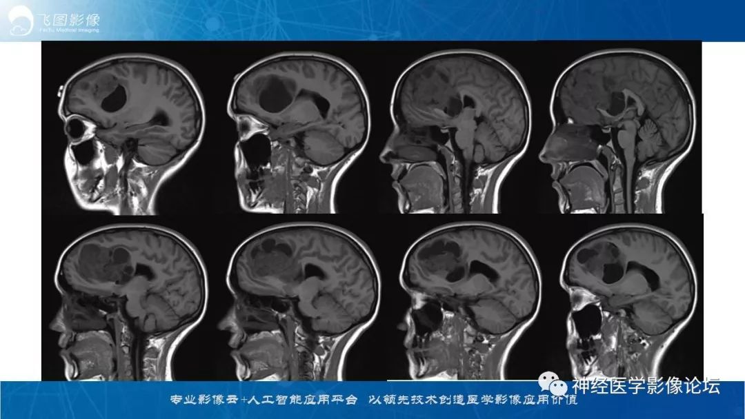 【病例】脑实质内室管膜瘤1例CT及MR影像表现