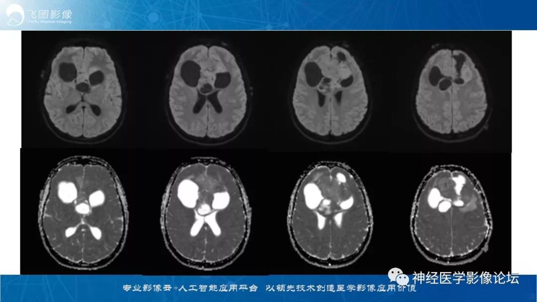 【病例】脑实质内室管膜瘤1例CT及MR影像表现
