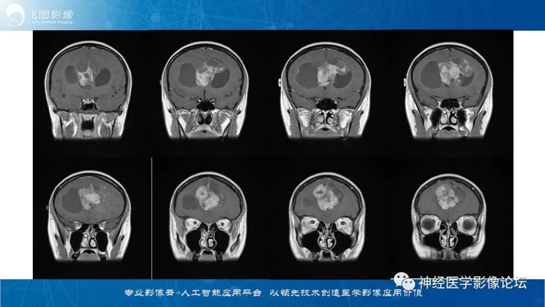 【病例】脑实质内室管膜瘤1例CT及MR影像表现