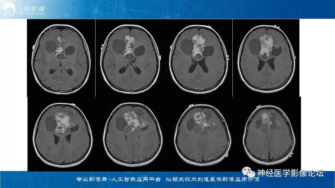【病例】脑实质内室管膜瘤1例CT及MR影像表现