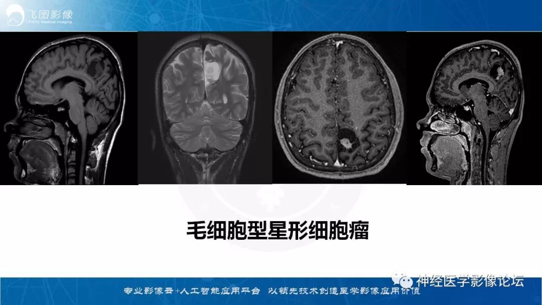 【病例】脑实质内室管膜瘤1例CT及MR影像表现
