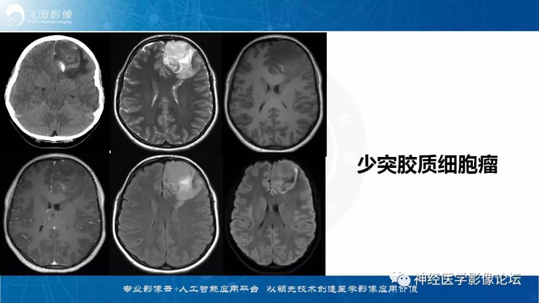 【病例】脑实质内室管膜瘤1例CT及MR影像表现